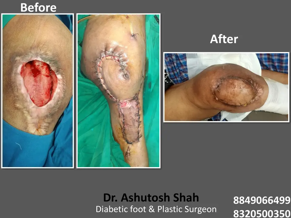 Diabetic Foot  PPT sunita.pptx-53.webp